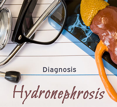 Global Hydronephrosis Drugs Market 2019-2023